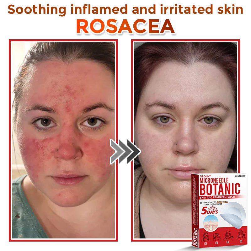 🇬🇧❣️𝐆𝐅𝐎𝐔𝐊® 𝐌𝐢𝐜𝐫𝐨𝐍𝐞𝐞𝐝𝐥𝐞 𝐁𝐨𝐭𝐚𝐧𝐢𝐜 𝐒𝐤𝐢𝐧 𝐓𝐚𝐠 𝐑𝐞𝐦𝐨𝐯𝐚𝐥 Patch