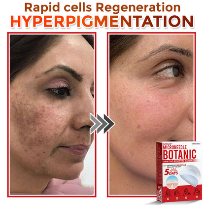 🇬🇧❣️𝐆𝐅𝐎𝐔𝐊® 𝐌𝐢𝐜𝐫𝐨𝐍𝐞𝐞𝐝𝐥𝐞 𝐁𝐨𝐭𝐚𝐧𝐢𝐜 𝐒𝐤𝐢𝐧 𝐓𝐚𝐠 𝐑𝐞𝐦𝐨𝐯𝐚𝐥 Patch