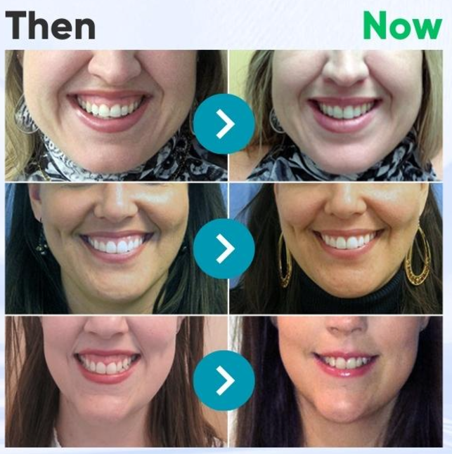 🇬🇧⭐️𝐅𝐮𝐫𝐳𝐞𝐫𝐨® 𝐅𝐨𝐜𝐮𝐬𝐬𝐦𝐢𝐥𝐞 𝐛𝐞𝐞 𝐯𝐞𝐧𝐨𝐦 𝐭𝐫𝐞𝐚𝐭𝐦𝐞𝐧𝐭 𝐩𝐨𝐰𝐝𝐞𝐫 𝐟𝐨𝐫 𝐨𝐫𝐚𝐥 𝐮𝐬𝐞🦷